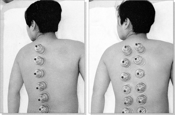 Cupping_set_Therapy_05